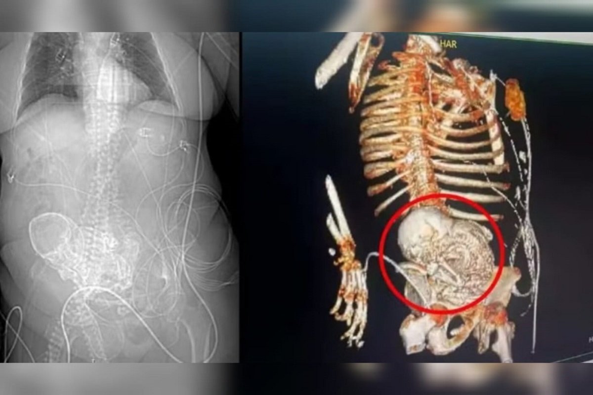 litopedia:-entenda-caso-do-feto-que-ficou-calcificado-no-corpo-da-mae